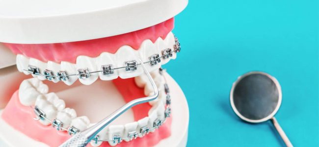 Are Braces Painful?