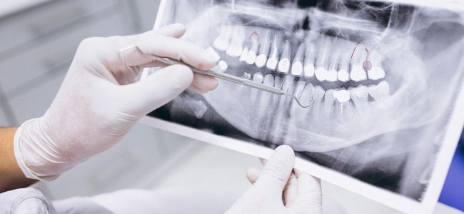 Are Dental X-Rays Safe?