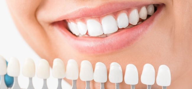 What is the Best Whitener for Your teeth?