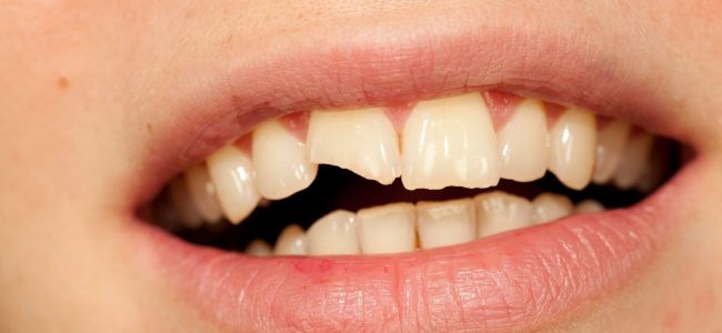 What Happens When You Leave a Cracked Tooth Untreated?