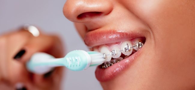 Can Braces Ruin Your Teeth?