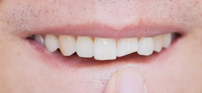 Can a Cracked Tooth Heal On Its Own?