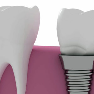 How Long Does a Dental Implant Procedure Take? Portrait