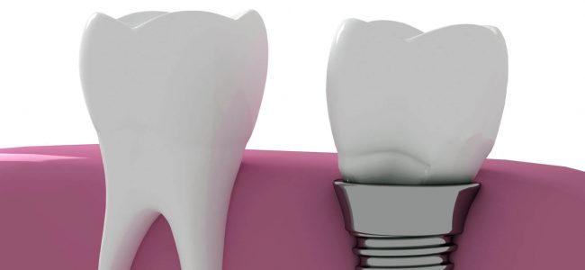 How Long Does a Dental Implant Procedure Take?