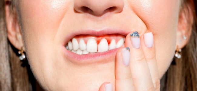 Does Gingivitis Hurt?