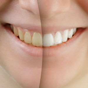 Is It Good to Do Teeth Whitening? Portrait