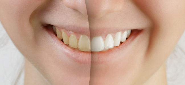 Is It Good to Do Teeth Whitening?