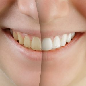 How Can I Whiten My Teeth Quickly? Portrait