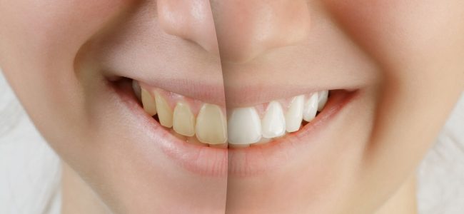 How Can I Whiten My Teeth Quickly?