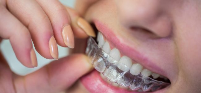 How Does Invisalign® Work?