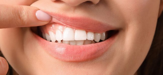 Do Gums Grow Around Implants?